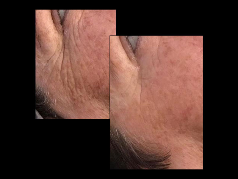 50-Glycolic-Kojic-and-Lactic-15-days-post-2