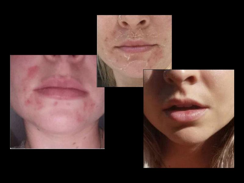 50-Glycolic-Kojic-and-Lactic-15-days-post