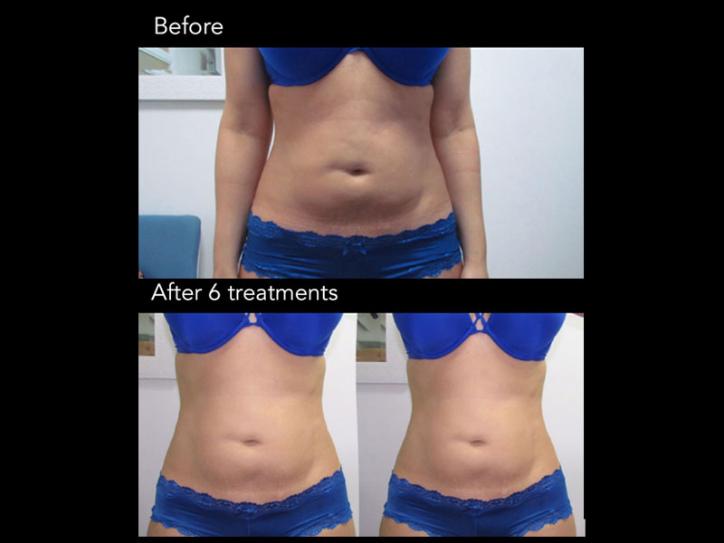 Laser-Lipolysis-1