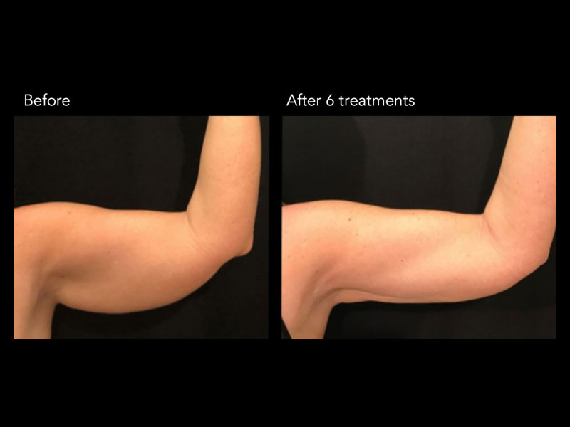 Laser-Lipolysis-2