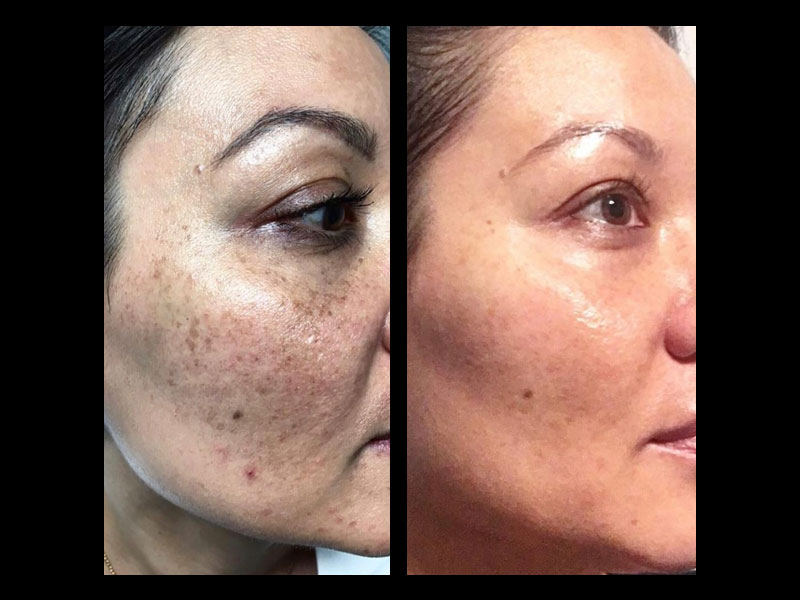 Transbright-Ultra-Peel-System-2-weeks-post