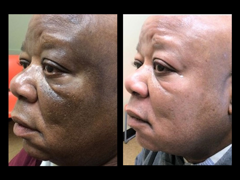 Transbright-Ultra-Peel-System-3-months-post.png