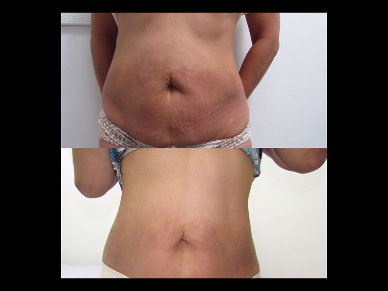 Tummy-2
