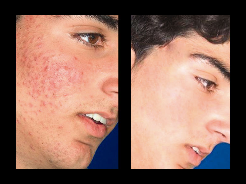 acne-2-(1)