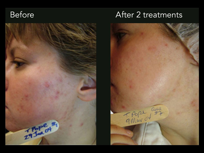 dermapen-1