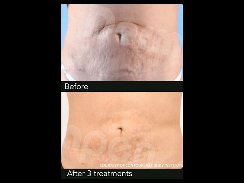 dermapen-2